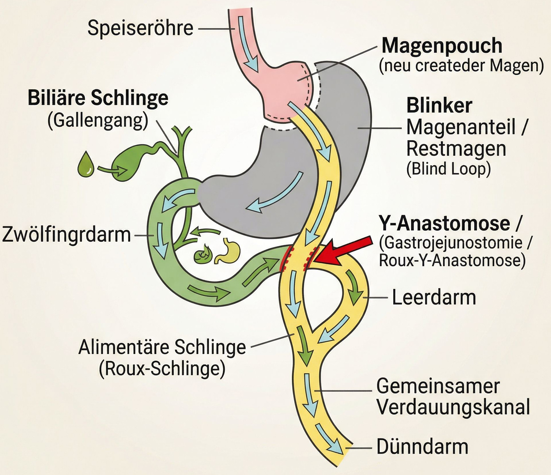 Buntes Diagramm des Roux-en-Y Magenbypass: farbige Abschnitte zeigen Magenpouch, Dünndarm, Gallenwege und Verdauungskanal in einer übersichtlichen Darstellung